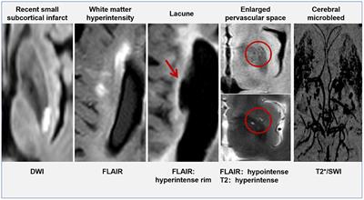 Advances in the Role of Endothelial Cells in Cerebral Small Vessel Disease